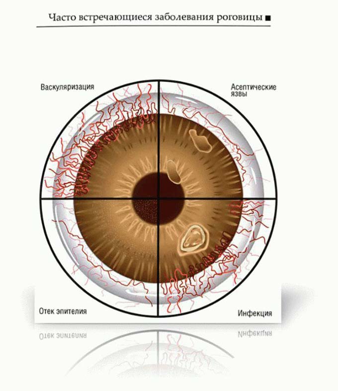 заболевания роговицы