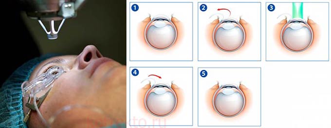 виды операций при астигматизме