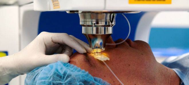 лазерная коррекция при астигматизме