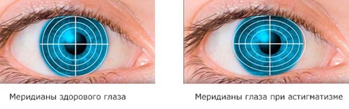 зрение при астигматизме