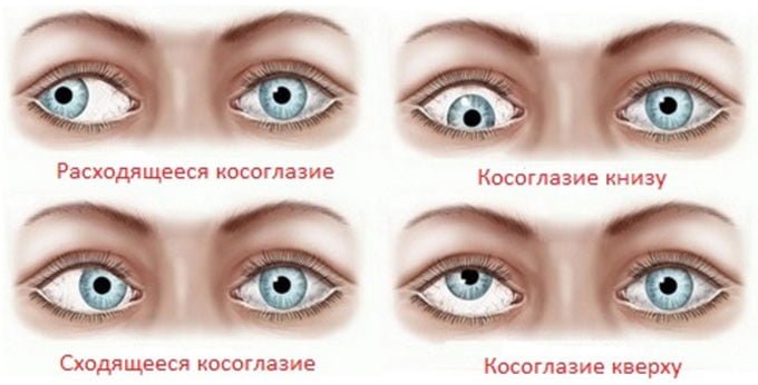 виды косоглазия