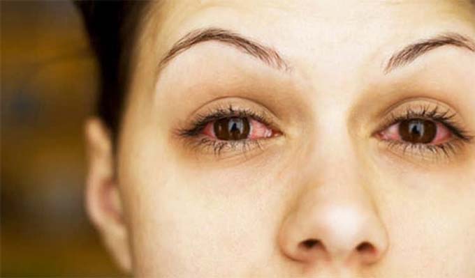 часто краснеют глаза