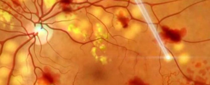 разрыв сетчатки глаза