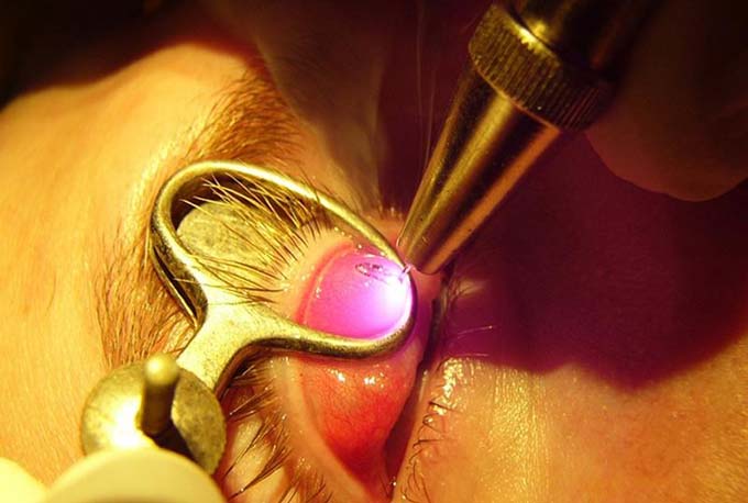 лечение халязиона лазером