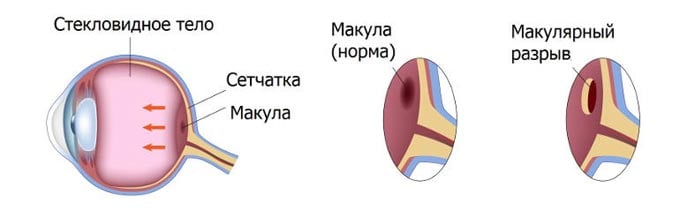 макулярный разрыв сетчатки