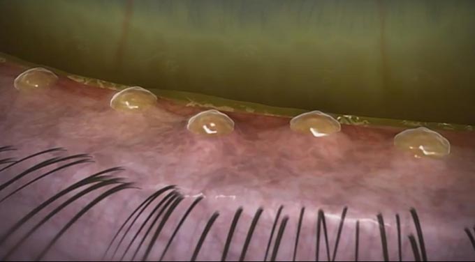 виды мейбомита век