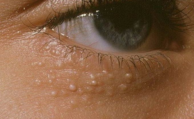 милиумы под глазами