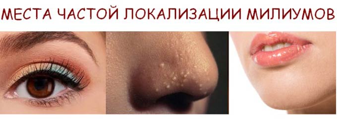 частая локализация милиумов