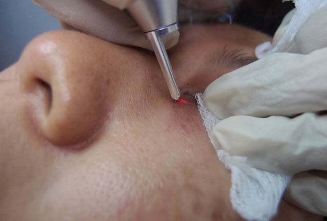 Электрокоагуляция