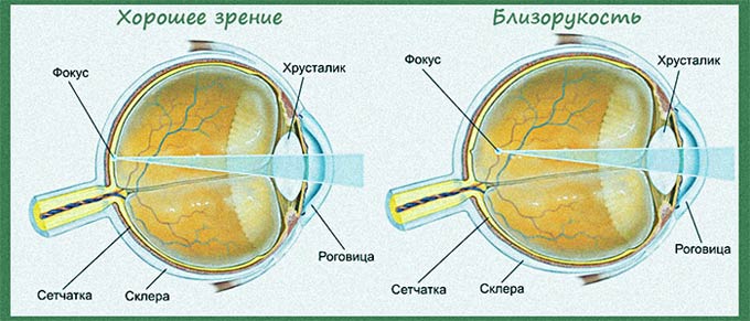 схема: хорошее зение и близорукость