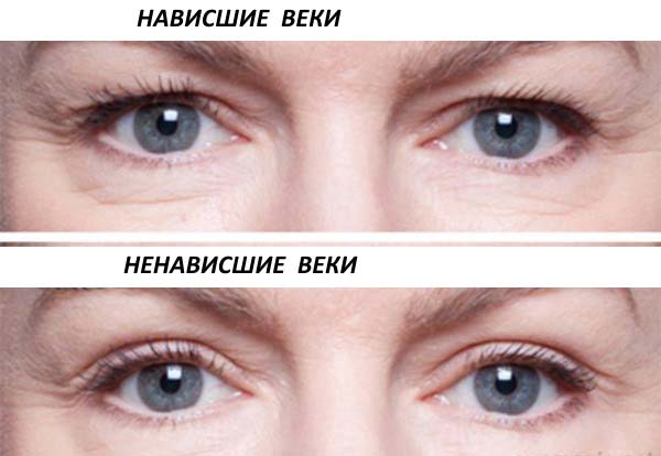 глаза с нависшим веком