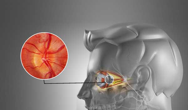 признаки неврита