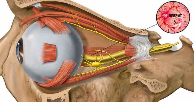 лечение неврита зрительного нерва