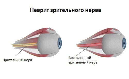 воспаление зрительного нерва