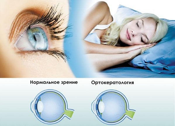 ночные линзы для восстановления зрения