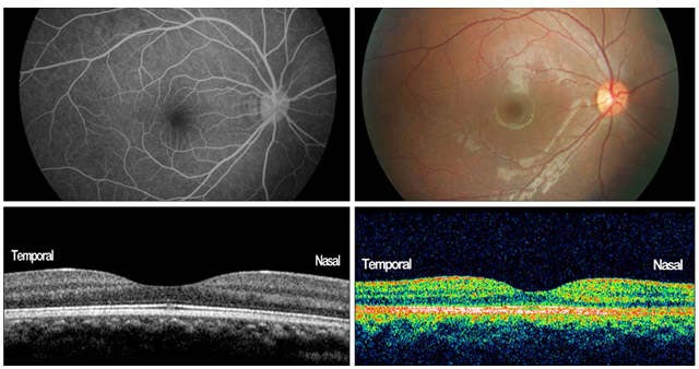 когерентная томография сетчатки