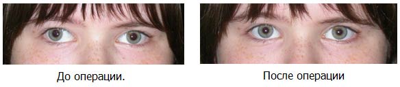 до и после операции на косоглазие