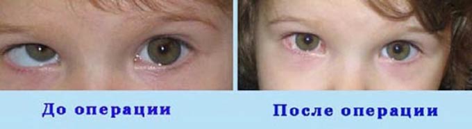 до и после операции у ребенка