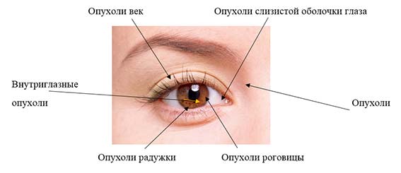 виды опухолей глаза