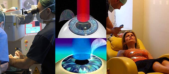 лазерная иридэктомия