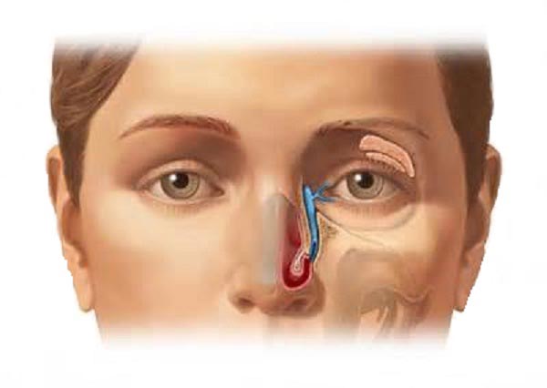 зондирование при дакриоцистите