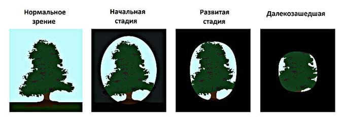 стадии глаукомы