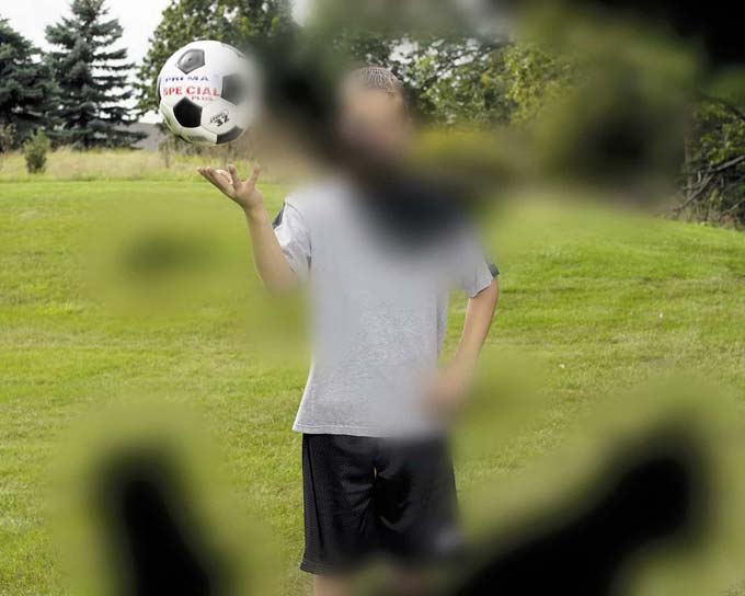 первые признаки катаракты глаза