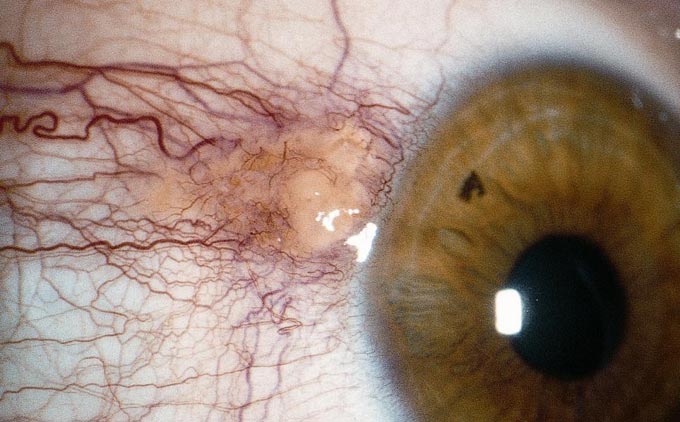 иссечение птеригиума