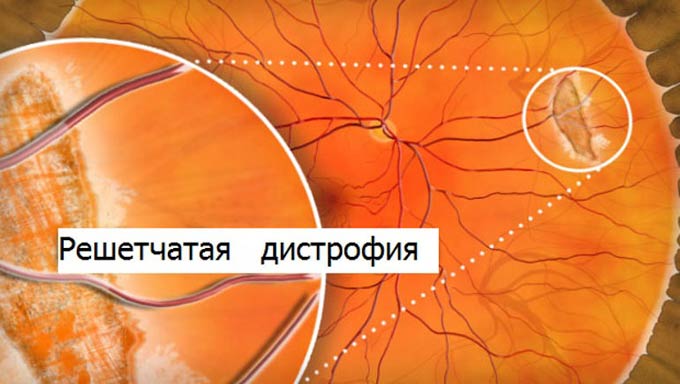 решетчатая дистрофия сетчатки