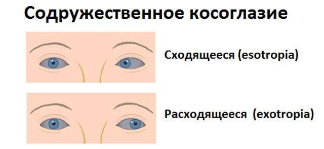содружественное косоглазие