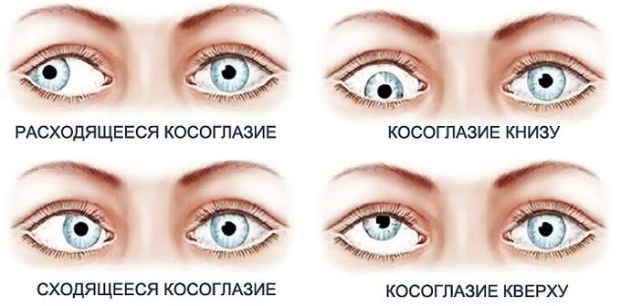 виды косоглазия