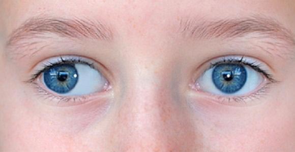 косит один глаз