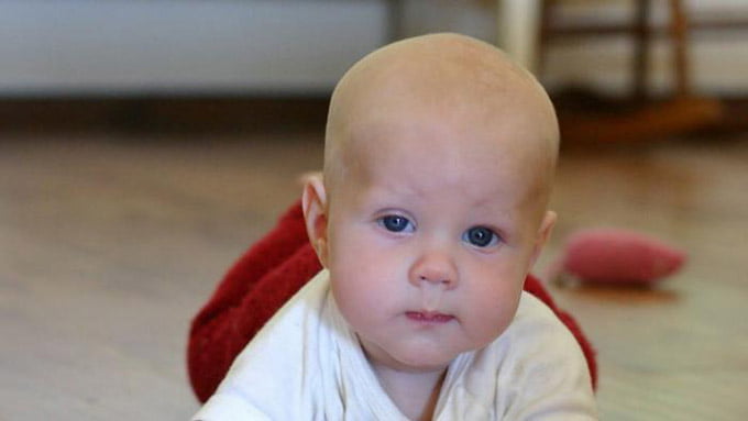 синдром горнера у детей