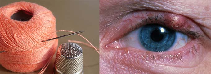 не прокалывайте ячмень