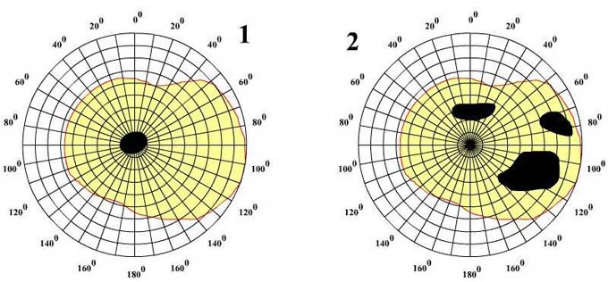 формы скотомы