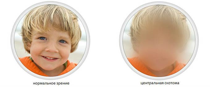 нормальное зрение и скотома