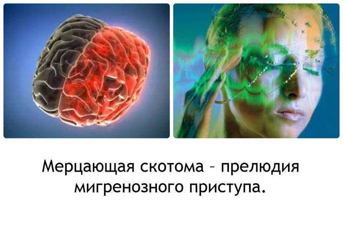 мерцательная скотома