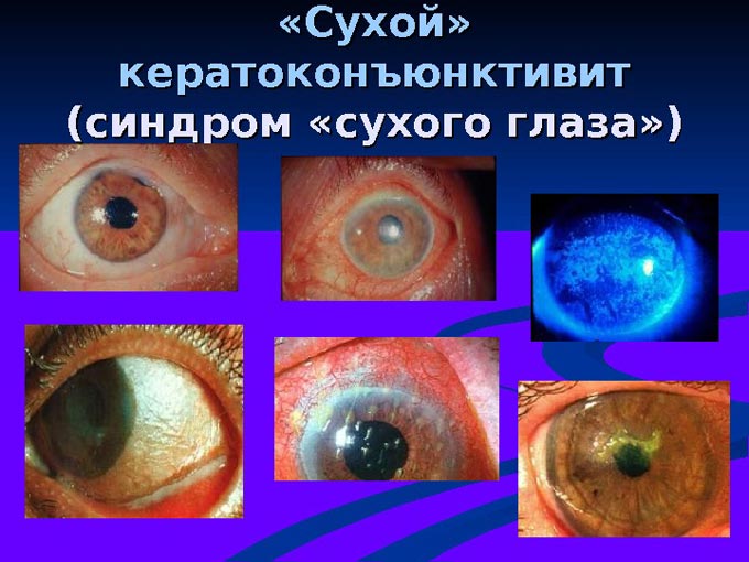 сухой кератоконъюнктивит