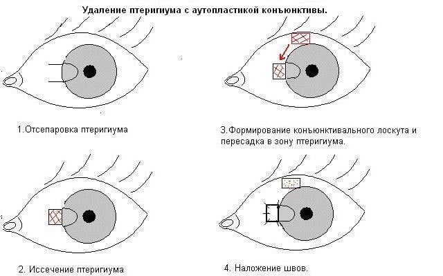 удаление птеригиума