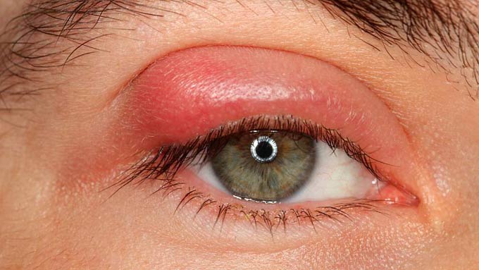 ячмень на веке