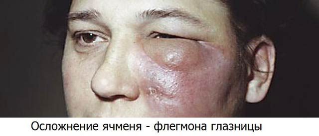 осложнения ячменя