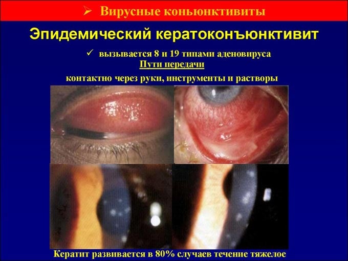 эпидемический кератоконъюнктивит
