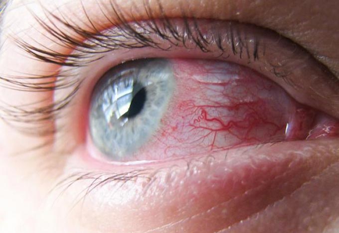 симптомы вирусного конъюктивита