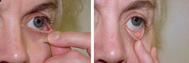 выворот века после блефаропластики