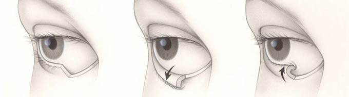 выворот нижнего века