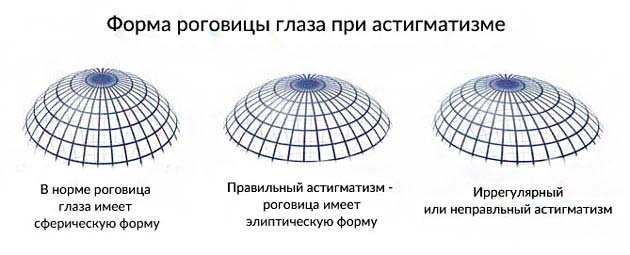 роговица при астигматизме