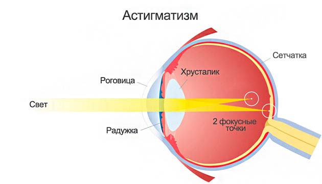 схема зрения при астигматизме