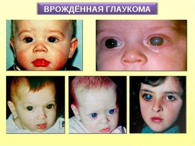 признаки врожденной глаукомы