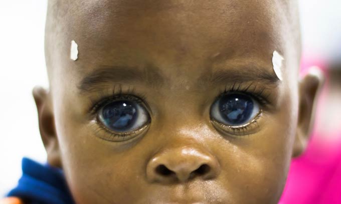 глаукома по наследству