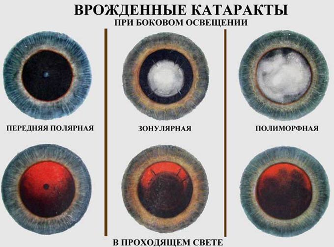 виды врожденной катаракты